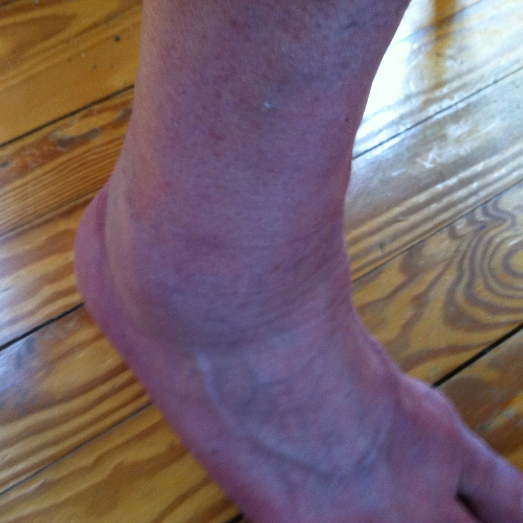 Ugly Ankle